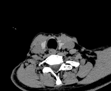 Carotid body tumor (Radiopaedia 61750-69757 Axial non-contrast 93).jpg