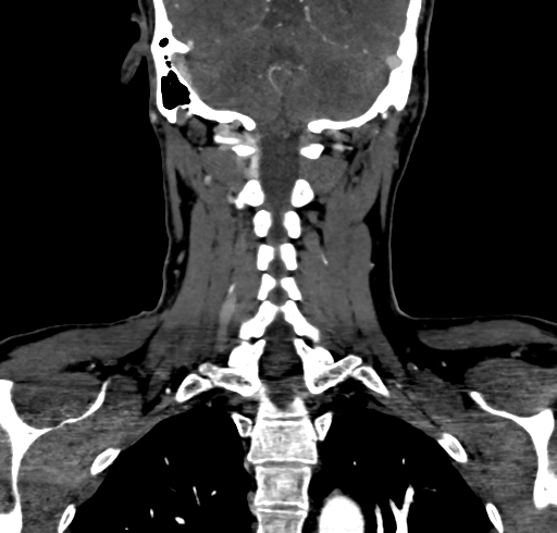 File:Carotid body tumor (Radiopaedia 83615-98727 B 98).jpg