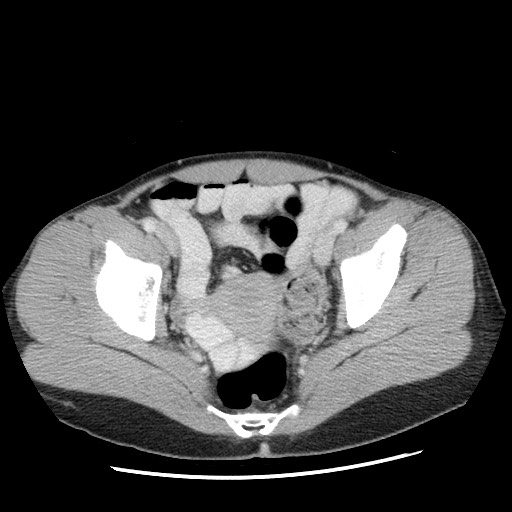 File:Castleman disease with fibrous pseudotumor in the abdomen (Radiopaedia 77296-89373 Axial 76).jpg