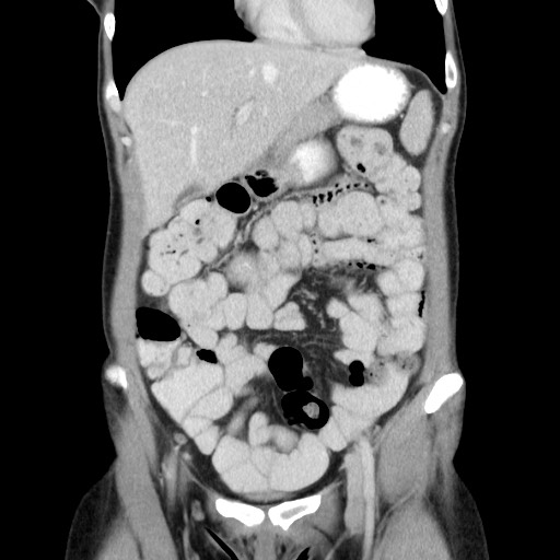 Castleman disease with fibrous pseudotumor in the abdomen (Radiopaedia 77296-89373 B 29).jpg