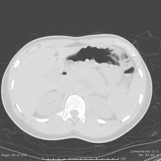 File:Catamenial pneumothorax (Radiopaedia 54382-60600 Axial non-contrast 92).jpg