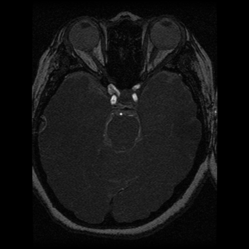 Cavernoma, DVA and right ICA aneurysm (Radiopaedia 33890-35072 E 56).png