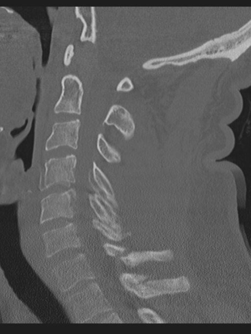 Cavernoma of cervical cord (Radiopaedia 50838-56346 Sagittal bone window 44).png