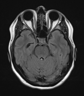 File:Cavernoma with bleed - midbrain (Radiopaedia 54546-60774 Axial FLAIR 11).png