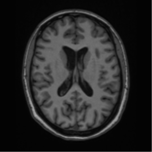 Cavernoma with bleed - midbrain (Radiopaedia 54546-60774 Axial T1 28).png