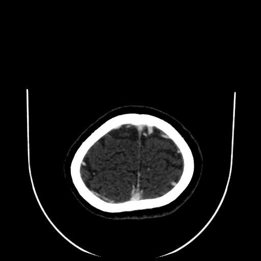 Cavernoma with developmental venous anomaly (Radiopaedia 22470-22506 C 182).jpg