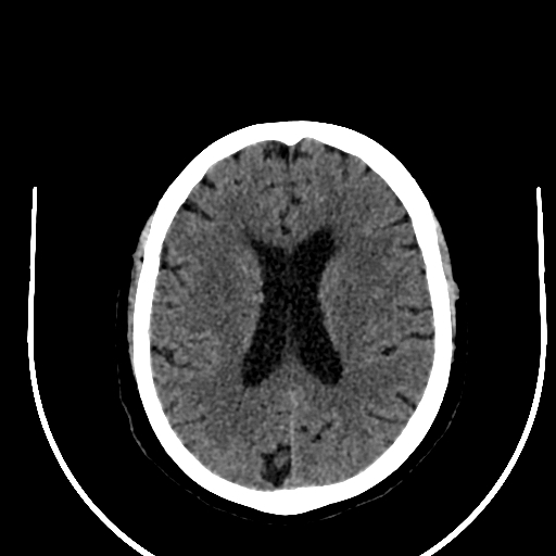 Cavernous hemangioma of the cerebellar falx (Radiopaedia 73025-83723 Axial non-contrast 86).jpg