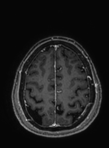 File:Cavernous hemangioma of the cerebellar falx (Radiopaedia 73025-83724 Axial T1 C+ 78).jpg