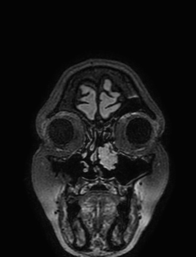 Cavernous hemangioma of the cerebellar falx (Radiopaedia 73025-83724 Coronal FLAIR 18).jpg