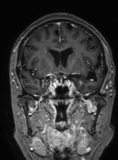 Cavernous hemangioma of the cerebellar falx (Radiopaedia 73025-83724 Coronal T1 C+ 153).jpg