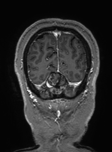 Cavernous hemangioma of the cerebellar falx (Radiopaedia 73025-83724 Coronal T1 C+ 333).jpg