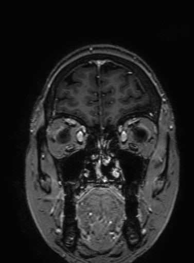 Cavernous hemangioma of the cerebellar falx (Radiopaedia 73025-83724 Coronal T1 C+ 66).jpg