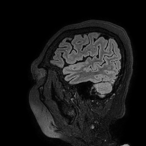 Cavernous hemangioma of the cerebellar falx (Radiopaedia 73025-83724 Sagittal FLAIR 187).jpg