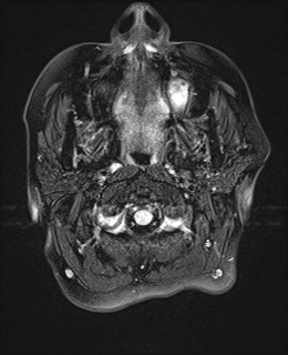File:Cavernous sinus meningioma (Radiopaedia 63682-72367 Axial FLAIR 1).jpg