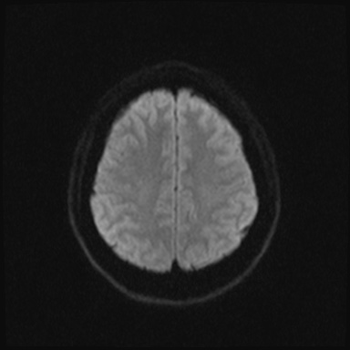 Cavernous sinus meningioma (Radiopaedia 63682-72367 DWI 37).jpg