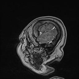 Cavernous sinus meningioma (Radiopaedia 63682-72367 Sagittal T1 C+ 149).jpg
