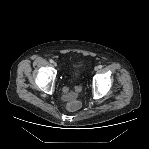 Cecal adenocarcinoma (Radiopaedia 64871-73817 A 87).jpg