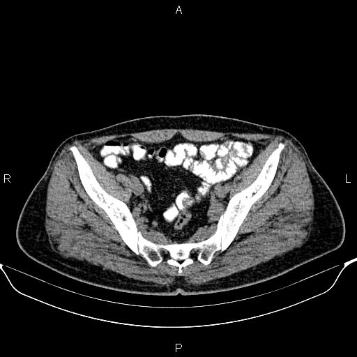Cecal adenocarcinoma (Radiopaedia 85324-100916 Axial non-contrast 81).jpg