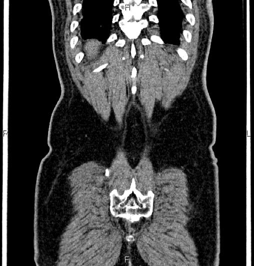 Cecal adenocarcinoma (Radiopaedia 85324-100916 D 63).jpg