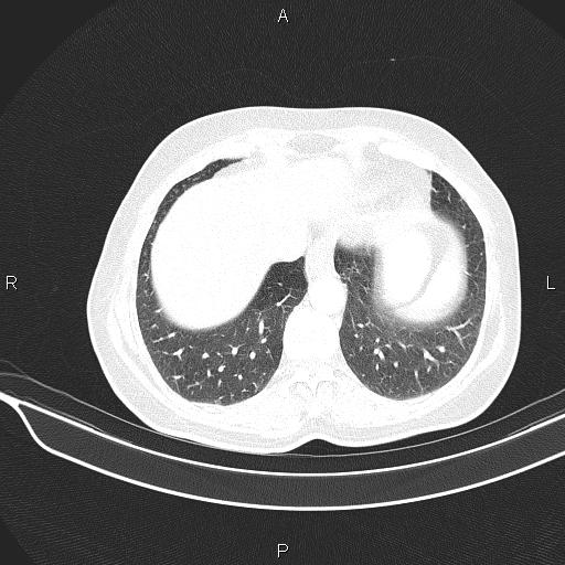 Cecal cancer (Radiopaedia 85610-101358 Axial lung window 51).jpg