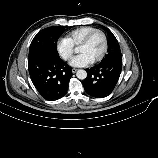 File:Cecal cancer with appendiceal mucocele (Radiopaedia 91080-108651 B 5).jpg