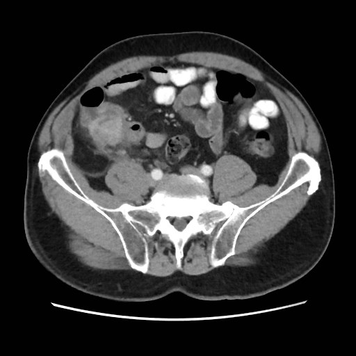 Cecal mass causing appendicitis (Radiopaedia 59207-66531 A 62).jpg