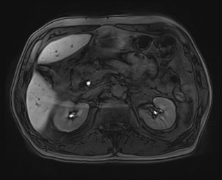 Cecal mass causing appendicitis (Radiopaedia 59207-66532 K 50).jpg