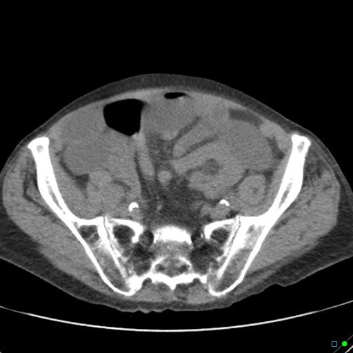 Cecal volvulus - atypical (Radiopaedia 21637-21588 non-contrast 54).jpg