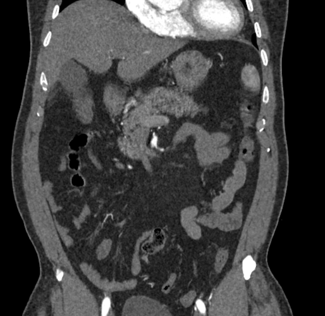 Celiac artery dissection (Radiopaedia 52194-58080 C 20).jpg
