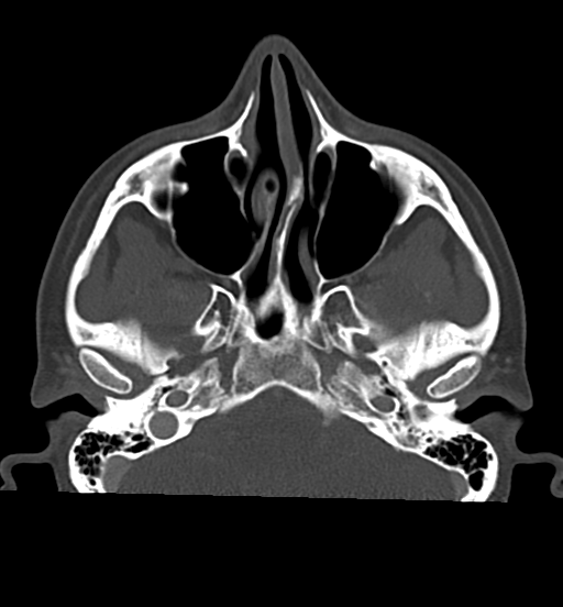 File:Cemento-ossifying fibroma (Radiopaedia 46243-50643 Axial bone window 24).png