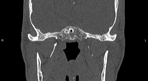 File:Central giant cell granuloma (Radiopaedia 83346-97761 Coronal bone window 25).jpg