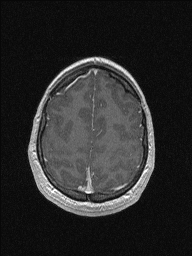 Central neurocytoma (Radiopaedia 56690-63469 Axial T1 C+ 137).jpg