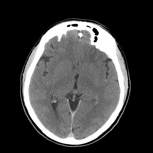 File:Central neurocytoma (Radiopaedia 68725-78432 Axial C+ 35).jpg