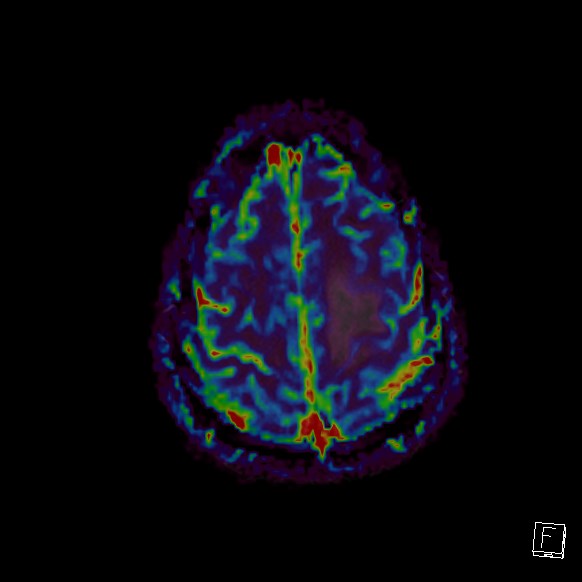 Central neurocytoma (Radiopaedia 84497-99872 Axial Perfusion 49).jpg
