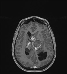 Central neurocytoma (Radiopaedia 84497-99872 Axial T1 C+ 93).jpg