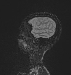 Central neurocytoma (Radiopaedia 84497-99872 Sagittal Flair + Gd 28).jpg