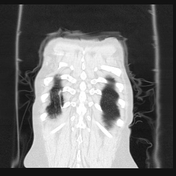 Centrilobular pulmonary emphysema (Radiopaedia 24495-24789 Coronal lung window 72).jpg