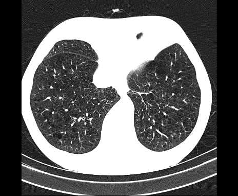 Centrilobular pulmonary emphysema (Radiopaedia 62468-70718 Axial lung window 61).jpg