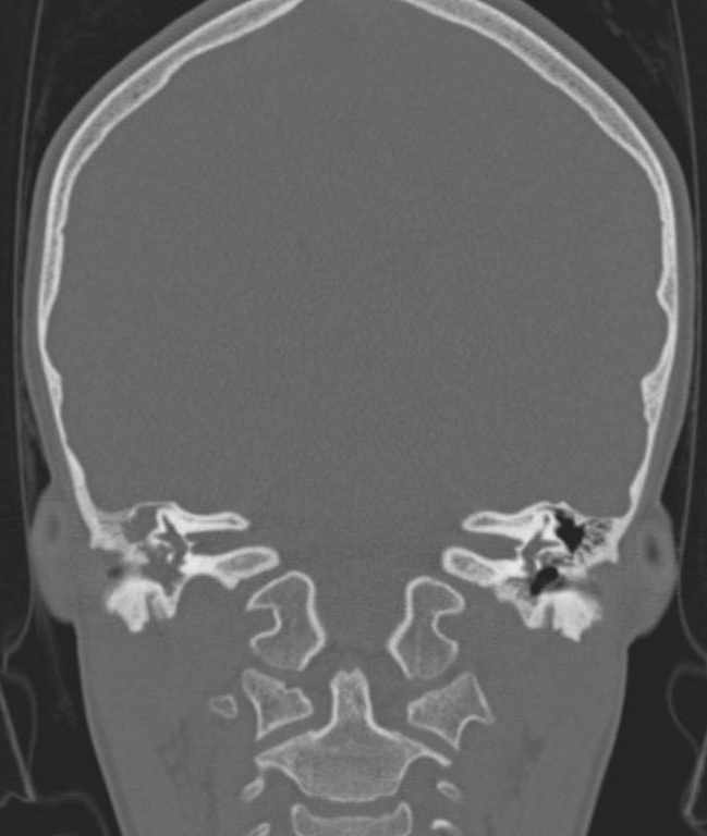 Cerebellar abscess (Radiopaedia 73727-84527 Coronal bone window 57).jpg