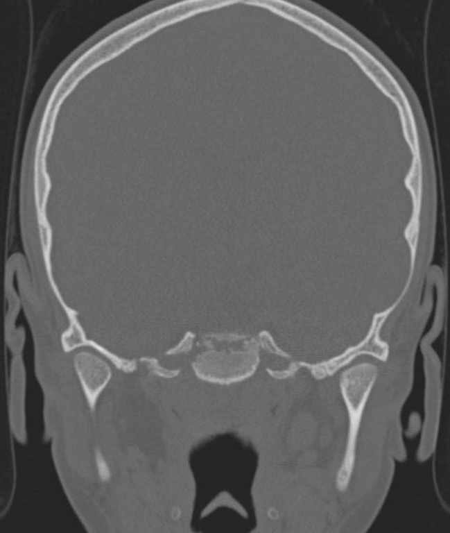 Cerebellar abscess (Radiopaedia 73727-84527 Coronal bone window 92).jpg