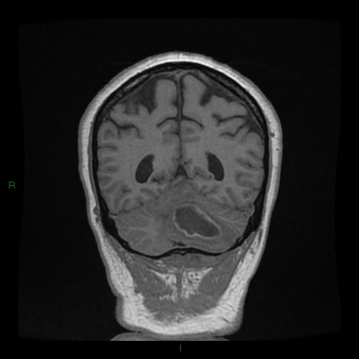 Cerebellar abscess (Radiopaedia 78135-90678 Coronal T1 C+ 124).jpg