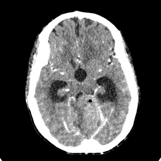 Cerebellar abscess secondary to mastoiditis (Radiopaedia 26284-26412 Axial C+ delayed 60).jpg