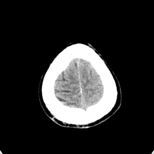 Cerebellar abscess secondary to mastoiditis (Radiopaedia 26284-26412 Axial non-contrast 144).jpg
