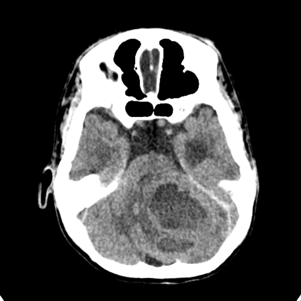 Cerebellar abscess secondary to mastoiditis (Radiopaedia 26284-26412 Axial non-contrast 46).jpg