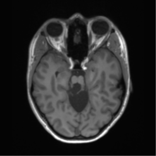 Cerebellar agenesis with hypoplastic pons (pontocerebellar hypoplasia) (Radiopaedia 57224-64138 Axial T1 29).png