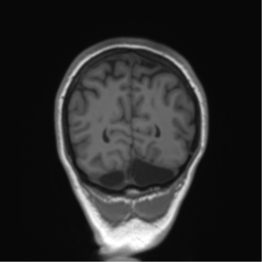 Cerebellar agenesis with hypoplastic pons (pontocerebellar hypoplasia) (Radiopaedia 57224-64138 Coronal T1 21).png