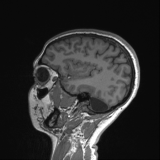 File:Cerebellar agenesis with hypoplastic pons (pontocerebellar hypoplasia) (Radiopaedia 57224-64138 Sagittal T1 49).png
