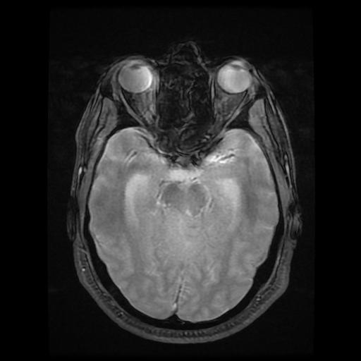 File:Cerebellar hemangioblastoma (Radiopaedia 88055-104622 Axial Gradient Echo 8).jpg