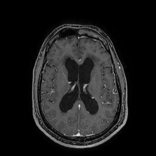 Cerebellar hemangioblastoma (Radiopaedia 88055-104622 Axial T1 C+ 105).jpg