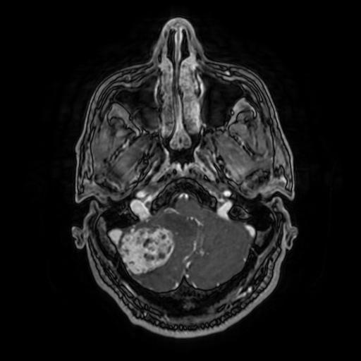 File:Cerebellar hemangioblastoma (Radiopaedia 88055-104622 Axial T1 C+ 43).jpg